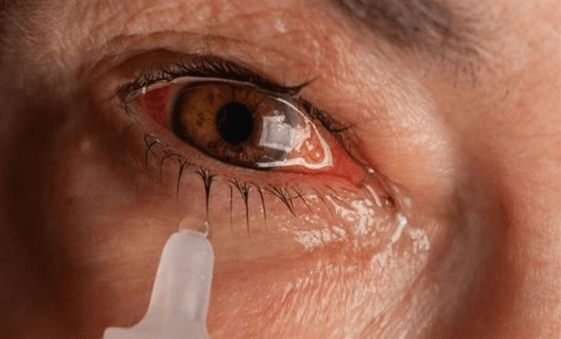 Conjunctivitis: What You Need to Know About This Common Eye Infection